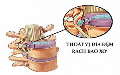 ĐIỀU TRỊ NHANH BỆNH RÁCH BAO XƠ ĐĨA ĐỆM CHỈ CÓ 20 PHÚT 